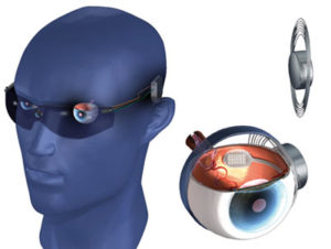 Imagen del sistema Argus II en la cual se observa, al lado izquierdo, una cabeza de maniquí portando las gafas que incorporan la microcámara en el puente , y en el lado derecho, un dibujo de un ojo seccionado donde se aprecia la ubicación del microchip y de la antena receptora de las imágenes procesadas