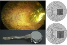 Imagen dividida en tres partes: la primera es la imagen de una retina donde se observa el microchip implantado sobre ésta, debajo se encuentra la imagen del microchip con su cubierta de silicona, y en la tercera parte observamos dos retinas dibujadas en las que se resalta la ubicación donde se implanta el microchip