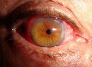 Imagen de un ojo con retinopatía diabética donde se observan los graves daños vasculares en forma de fugas de sangre que se pueden llegar a dar en esta enfermedad.