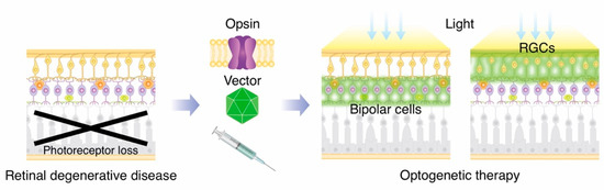 Esquema de un tratamiento optogenético para enfermedades degenerativas de la retina. A la izquierda, se muestra una retina afectada por una enfermedad degenerativa, marcada como "Retinal degenerative disease", donde las células fotorreceptoras están ausentes ("Photoreceptor loss") y esto se señala con una gran equis negra. En el centro, se ilustra la introducción de una terapia, donde se administra una opsina (proteína sensible a la luz) mediante un vector, representado por una estructura viral y una jeringa. A la derecha, bajo el título "Optogenetic therapy", se muestran dos formas de terapia: una en la que la proteína opsina se dirige a las células bipolares, y otra donde la opsina se dirige a las células ganglionares de la retina (RGCs). Ambas permiten que la retina degenerada pueda responder a la luz nuevamente, gracias a que estas células adquieren la capacidad de captar la luz y transmitir señales visuales a pesar de la pérdida de los fotorreceptores originales.