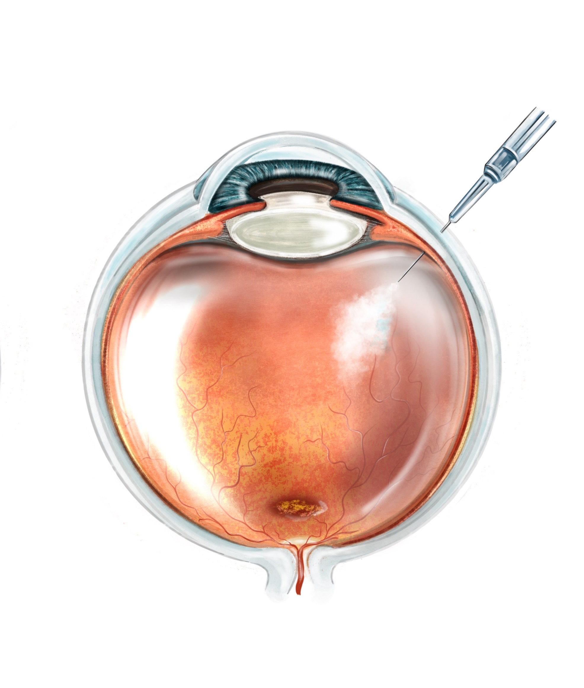 Ilustración médica mostrando un corte transversal de un ojo humano. En la imagen, una jeringa está introduciendo una aguja en el costado del ojo, hacia la retina. Esto representa una inyección intravítrea, una técnica comúnmente utilizada para administrar medicamentos, terapias génicas u otros tratamientos directamente dentro del globo ocular, hacia la parte que contiene el humor vítreo. Se observa cómo la sustancia inyectada se dispersa dentro del ojo, señalada por una zona más blanca y difusa.